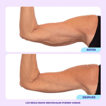 Lifting de Brazos ®