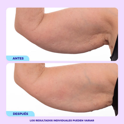 Lifting de Brazos ®
